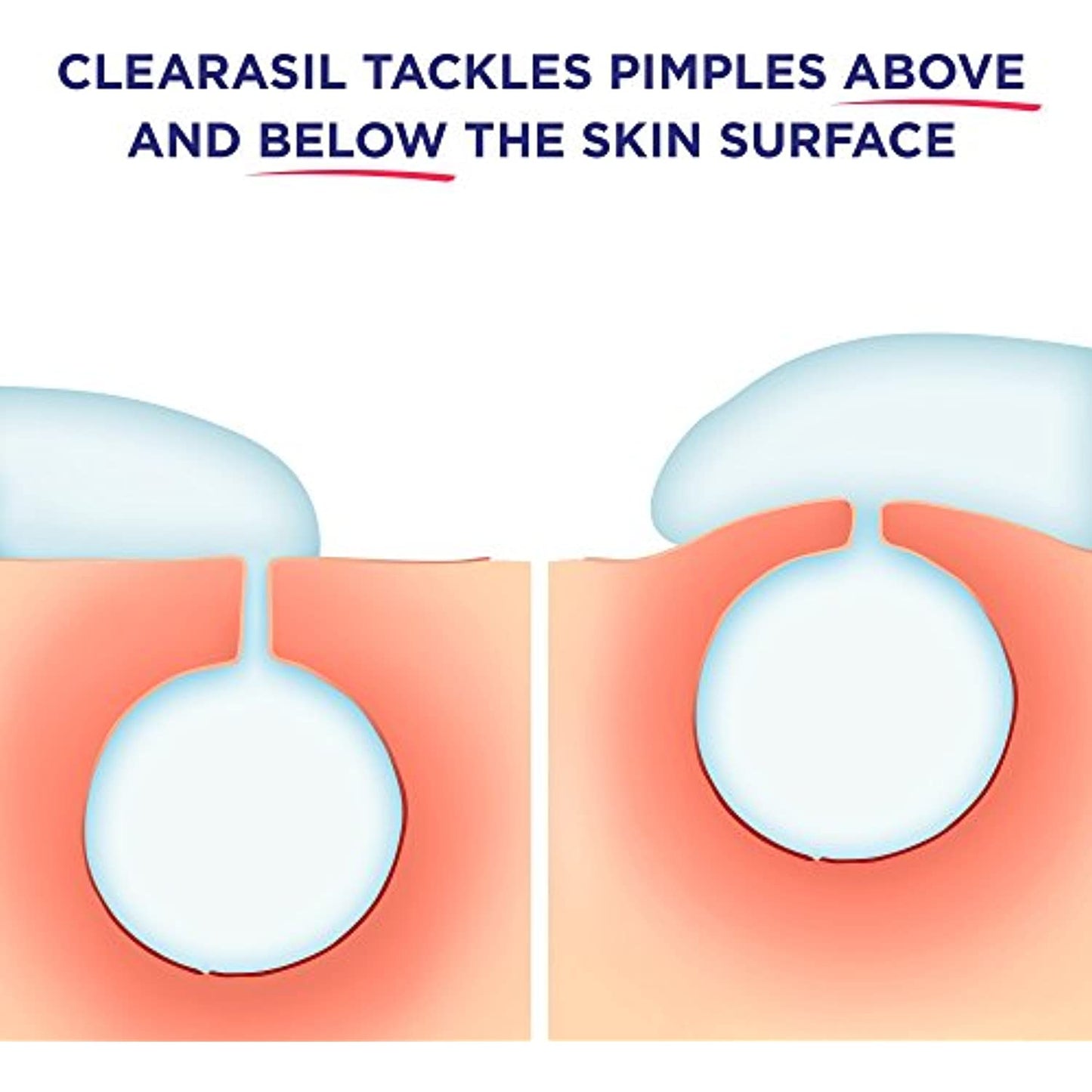 Clearasil Rapid Rescue, Deep Treatment Wash 6.78 oz (Pack of 3) EXP 10/22
