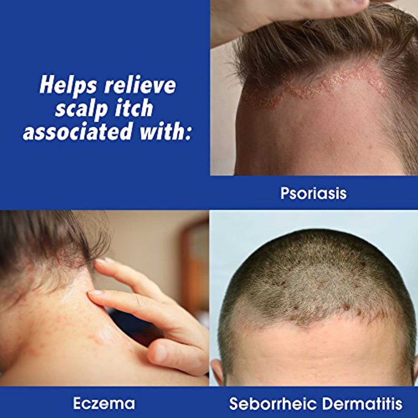 Scalpicin Scalp Itch Relief, 1.5 fl Oz. Maximum Strength (Pack of 6)
