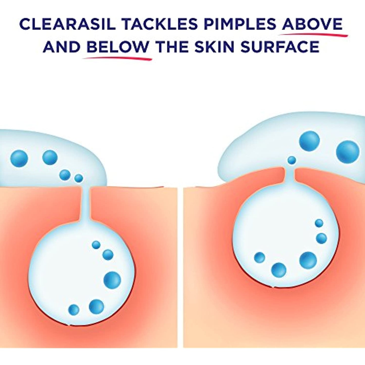 6 pack Clearasil Stubborn Acne Control 5in1 Exfoliating Wash 6.78 fl. oz